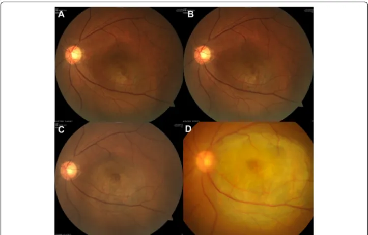 Fig. 2 Potential adverse effect of intravitreal bevacizumab injection on tumor growth