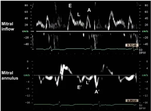Figure 1 Mitral inflow and annulus velocity pattern in a patient with triphasic mitral inflow with prominent mid- mid-diastolic filling (L)