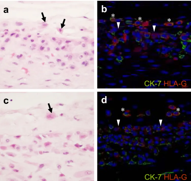 Figure 1. Histologic and immunophenotypic characteristics of ‘trophoblast islands of the chorionic connective tissue’ (TICCT)