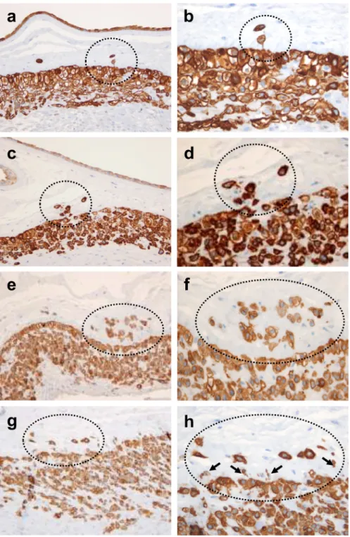 Figure 2. Histological spectrum of TICCT confirmed by immunostaining against cytokeratin-7 a, b: Isolated trophoblasts in the chorionic connective tissue in a case of normal term delivery at 37.4 weeks of gestation