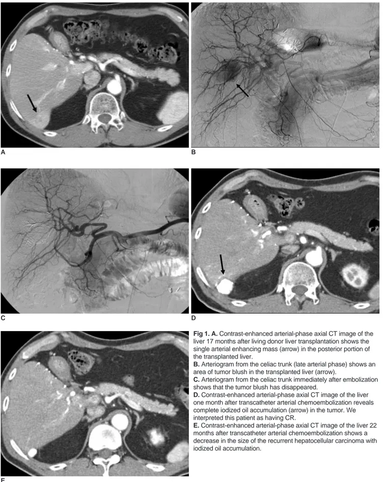 Fig 1. A. Contrast-enhanced arterial-phase axial CT image of the liver 17 months after living donor liver transplantation shows the single arterial enhancing mass (arrow) in the posterior portion of the transplanted liver