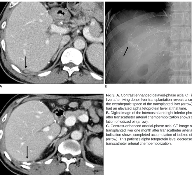 Table 3. Targeted Lesion Tumor Response to TACE