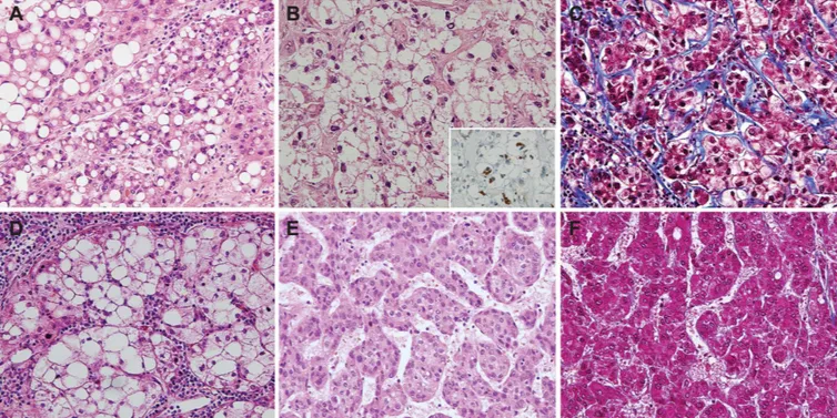 Fig 1. Pathological features of the steatohepatitic hepatocellular carcinoma (SH-HCC) and conventional HCC (C-HCC)