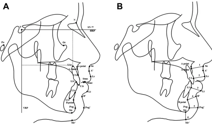 Figure 1. Landmarks, reference lines, and definitions of measurement for cephalometric analysis