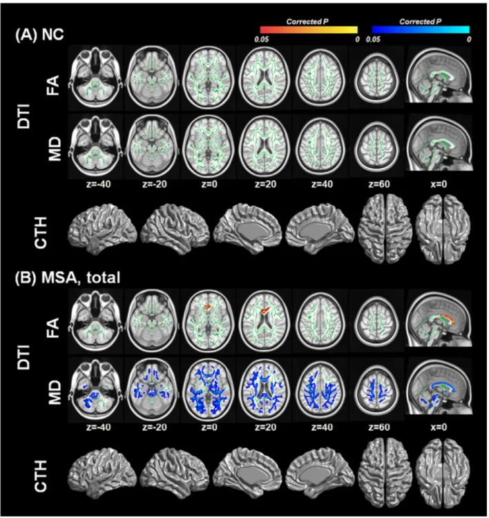 Figure 1. White matter integrity and cortical thickness associated with serum urate levels (A) in normal controls and (B) in patients with MSA