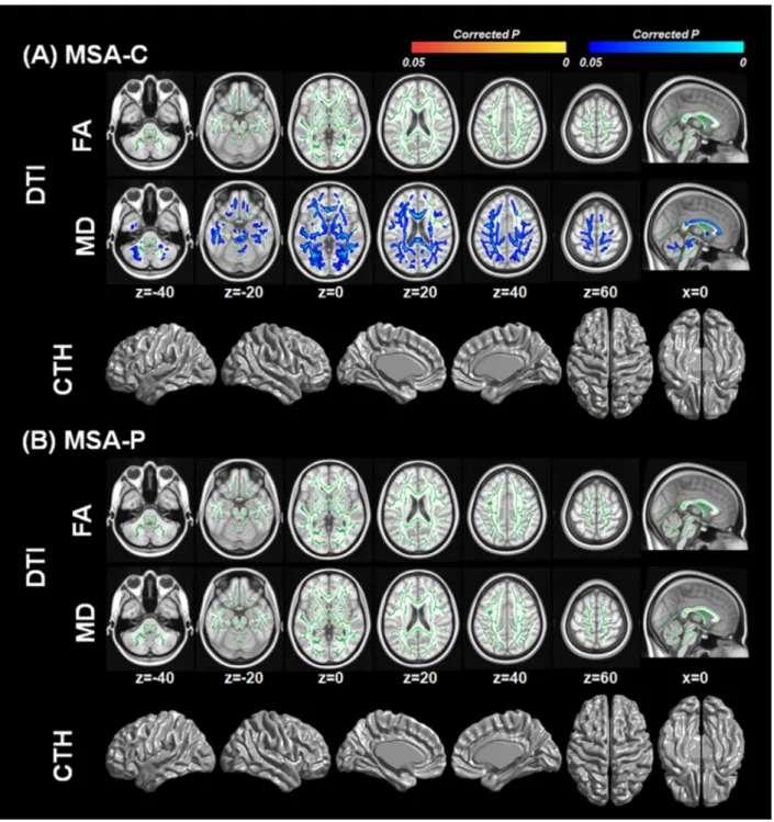 Figure 3. White matter integrity and cortical thickness associated with serum urate levels according to clinical subtype
