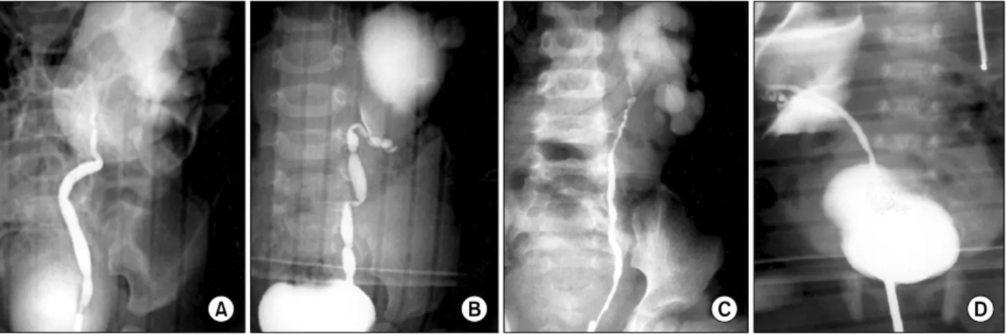 Fig.  1.  The  type  of  ureteral  narrowing.  (A)  Narrowing  of  the  UPJ  only.  (B)  Multiple  ureteral  narrowing