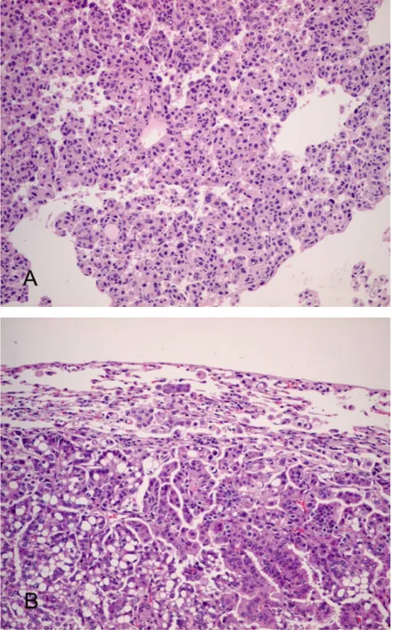 Fig. 4. Bronchioloalveolar carcinoma and adenocarcinoma developed in the mouse lung  tissues  at  28  weeks  and  48  weeks  after  urethane  administration,  respectively