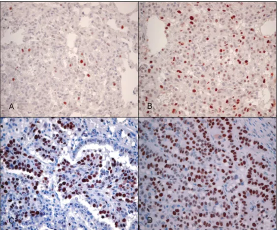 Fig.  7.  PCNA  immunoreactivity  in  urethane-induced  mouse  lung  tissues  showing  alveolar  hyperplasia  (A),  atypical  adenomatous  hyperplasia  (B),  bronchioloalveolar  carcinoma  (C),  and  adenocarcinoma  (D)