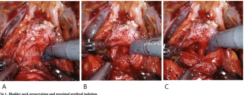 Fig 1. Bladder neck preservation and proximal urethral isolation.