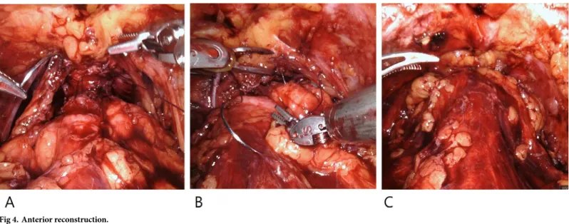 Fig 4. Anterior reconstruction.