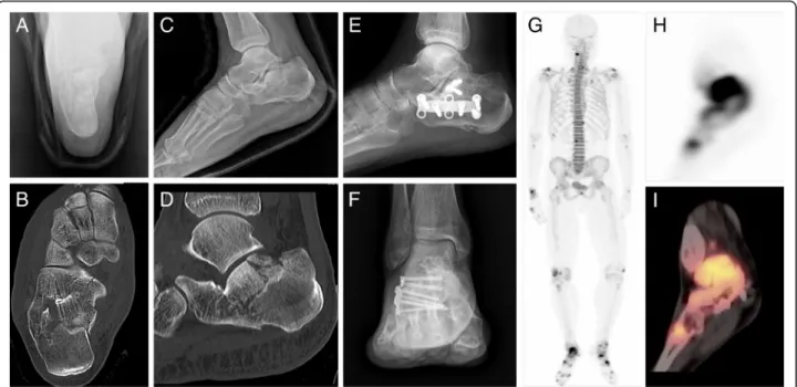 Fig. 2 Radiologic and 18 F-sodium fluoride (18F-NaF) positron emission tomography-computed tomography (PET/CT) images of a 53-year-old male patient who had a right calcaneus fracture and underwent operation with plate-screw fixation