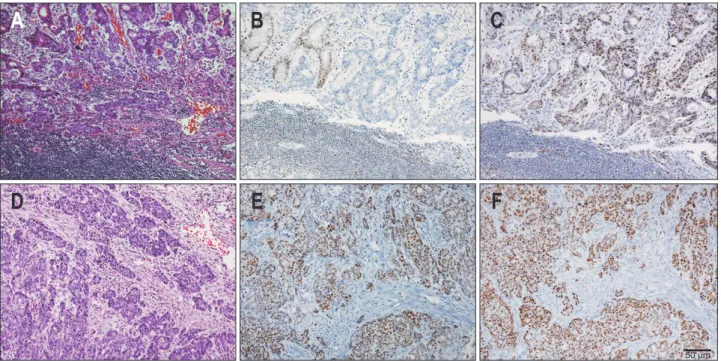 Fig. 1. Representative histology and immunohistochemistry results. A microsatellite instability-high (MSI-H) case (A) exhibiting the loss of the ex- ex-pression of hMLH1 (B) and the intact exex-pression of hMSH2 (C)