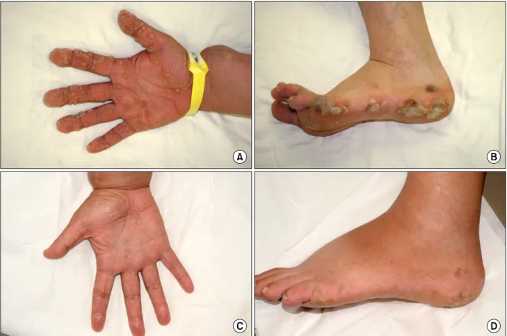 Fig. 1. Skin  lesions  before  and  after  sirolimus  conversion.  The  patient  complained  of  severe  skin  warts  on  the  hands  and  feet  (A,  B)