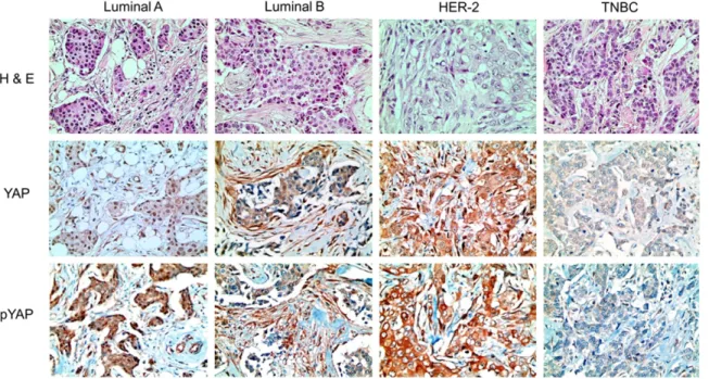 Figure 1. Expression of YAP and pYAP according to the molecular subtype of breast cancer