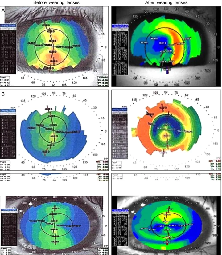 Figure 1. Causes of failure on corneal topography within 3 months. (A), (B), and (C) show an example of corneal topologies for the  patients of failure group with decentration, central island, and incomplete corneal reshaping, respectively