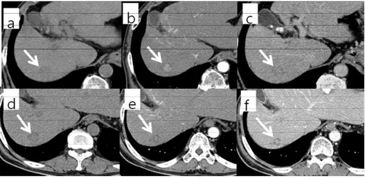 그림  3) 77세  남자  환자가  간경변증으로  추적검사  중  (a)  조영  전  CT 에서  1.5cm의  저음영  결절이  관찰된다.  (b)  동맥기에  내부에  1.4cm  크기의  조영증강  결절을  보이며  (c)  지연기  영상에서    조영배출을  보 이고  있다