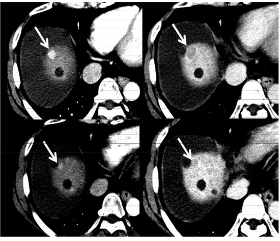 그림  4)  62세  남자  환자가  간경변증으로  추적검사  중  (a)  동맥기  조 영증강을  보이고  (b)  지연기  조영배출을  보이는  1.4cm  크기의  간세포 암을  보인다