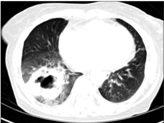 Figure  2.  The  chest  X-ray  shows  consolidation  on  the  right  lower  lung  field.