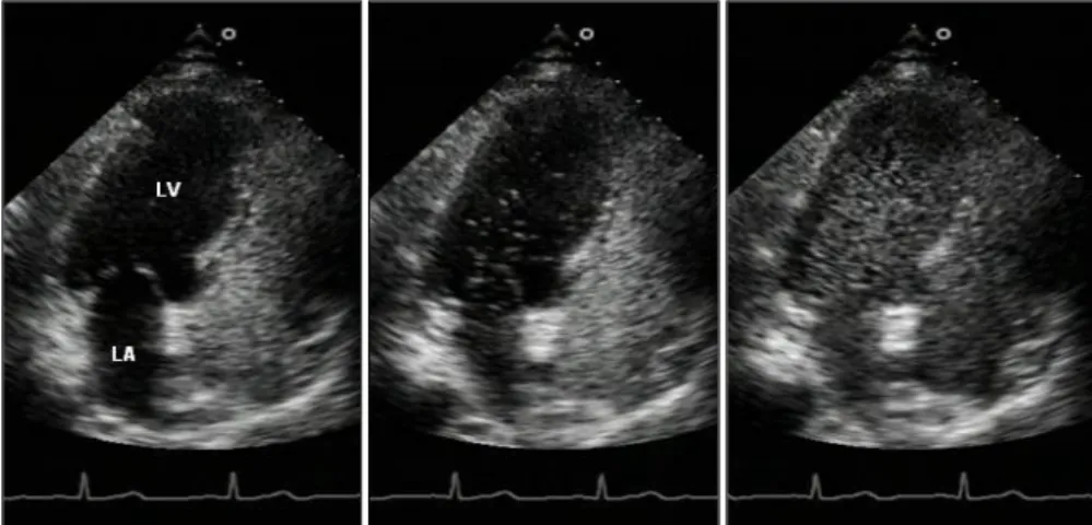Fig. 1. Contrast echocardiogra-