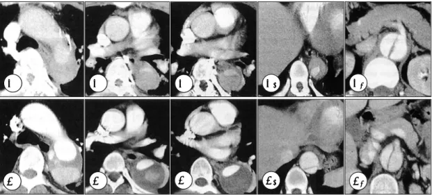 Fig. 1. Initial and follow-up CT scans taken 4 weeks later. Initial CT scans show aortic dissection from proximal