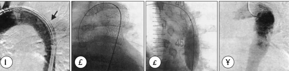 Fig. 3. The process of endovascular Stent-graft implantation. A：After positioning of Stent-graft delivery set at 