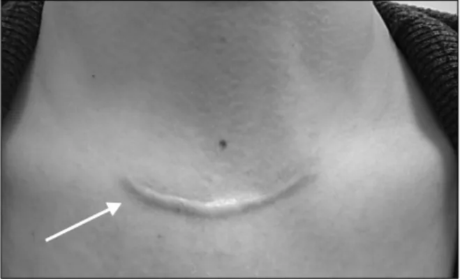 Fig.  2.  (A)  Photograph  of  a  postoperative  single  incision  axillary  scar  3  months  after  robotic thyroidectomy