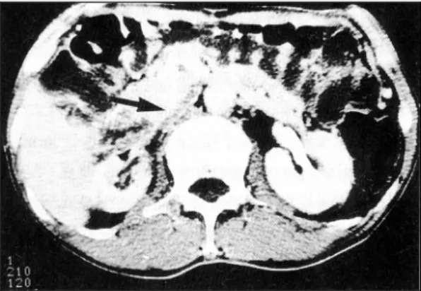 Fig. 1. Contrast-enhanced CT scan shows severe narro-