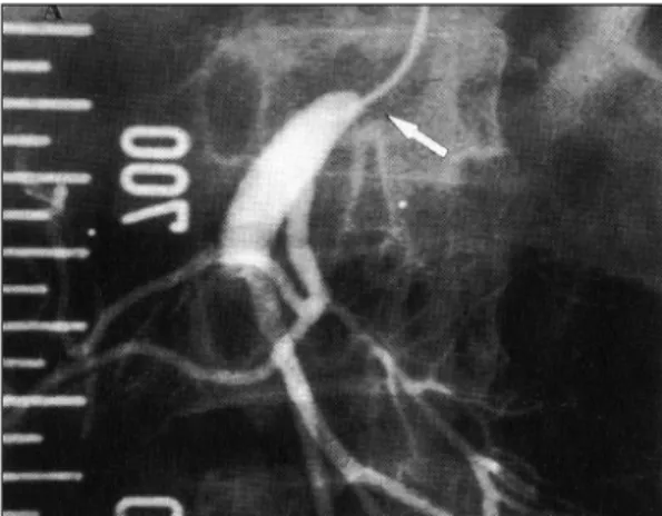 Fig. 5. After adjuvant high pressure ballooning, angiogr-