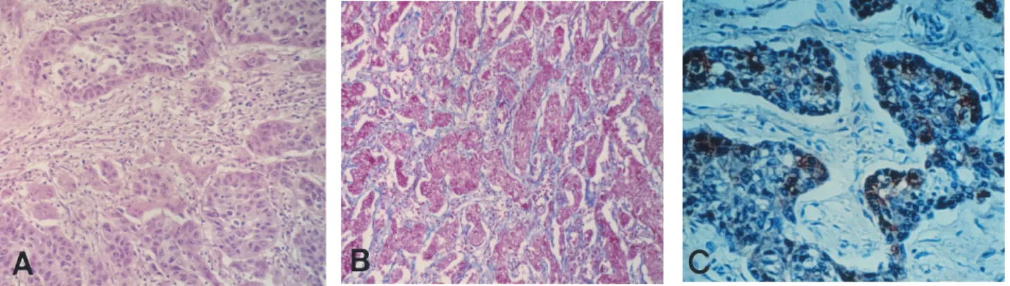 Figure 2 . Microscopic and immunohistochemical finding of sclerosing hepatic carcinoma (SHC)