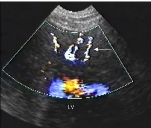 Fig. 1. Transthoracic color Doppler echocardiography showed multiple linear color flow signals (arrow)  per-pendicular to the epicardial surface in the left  vent-ricular apex, which was drained into left ventricle,  de-monstrating multiple left coronary a