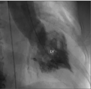 Fig. 2. Left coronary angiography showed multiple mi- mi-crofistulae originating from 1st diagonal branch (D1) of left coronary artery and draining into the left ventricular cavity (arrow)