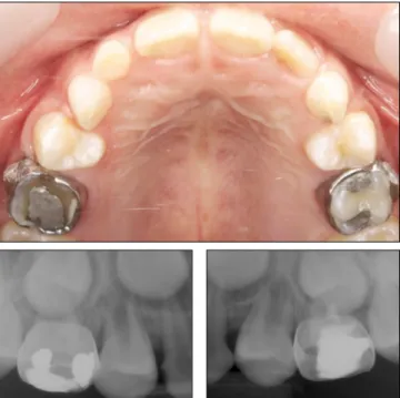 Fig. 3. Panoramic view showed the roots of both premolars were in the
