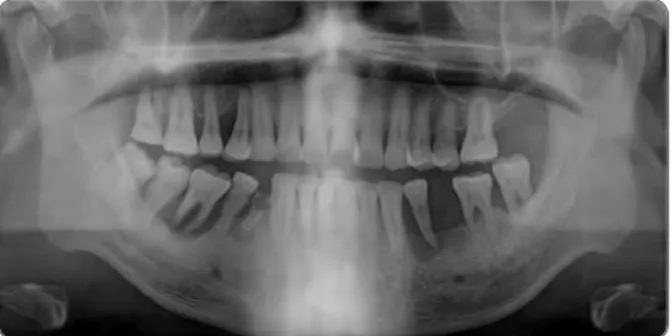 Fig. 2. Clinical view of right(A) and left(B) ridge 2 months  following teeth extraction.