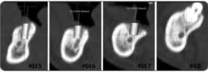 Fig. 7. Clinical photographs of the surgical site.  A. Vertical bony defects around the implants