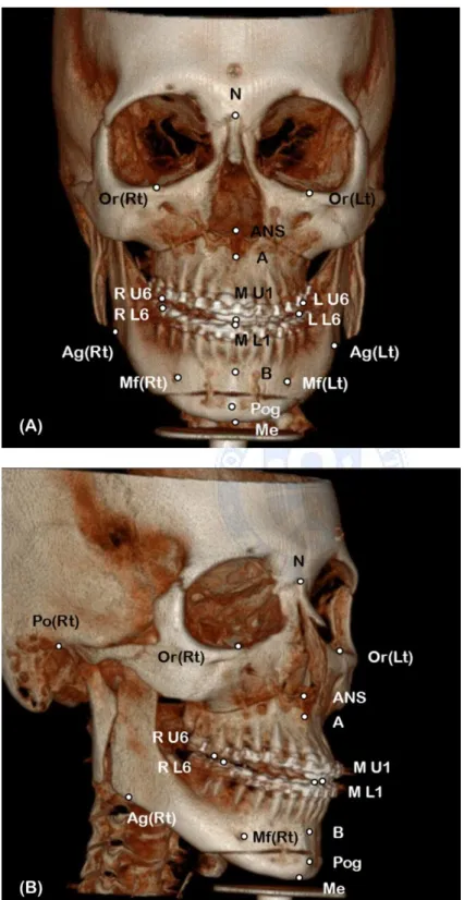 Figure 3. Hard tissue landmarks (A) frontal view (B) oblique view