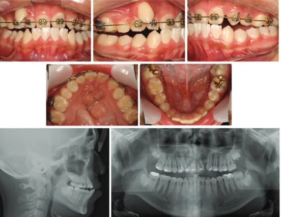 Figure 1. Pretreatment intraoral views and radiographs.한  총생을  보인다.  그러므로  치아의  배열과  상악 