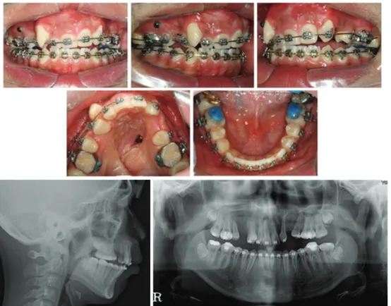 Figure 2. Intraoral views and radiographs after Distraction osteogenesis.