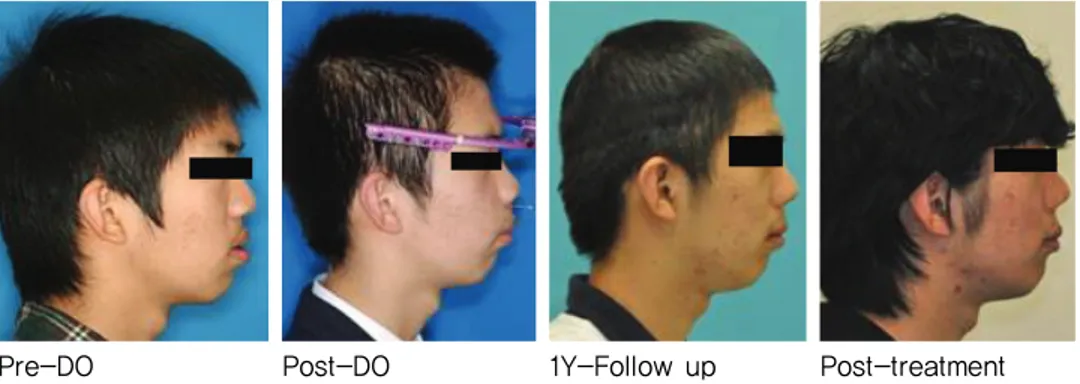 Figure 6. Superimposition of pre-Do, post-DO  and 1Y-F/U. pre-Do post-DO1Y-F/U이번  증례에서  신장  기간  동안  전방부  분절골의 수직적인 이동이 관찰되었다