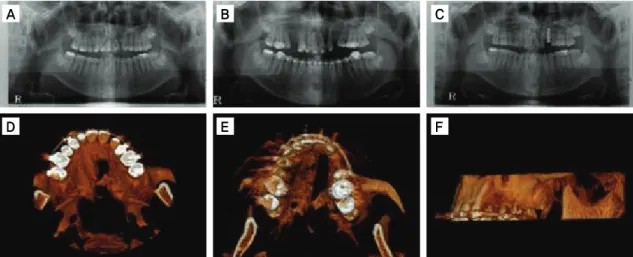 Figure 7. Investigation of alveolar bone using panoramic X-ray scanning and three-dimensional  computed tomography