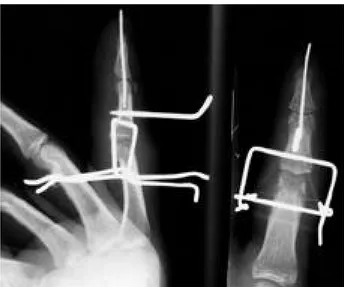 Fig. 1. Postoperative radiographs of external fixation with a hinged external fixation fixator, lateral(left) and posteroanteror (right) view