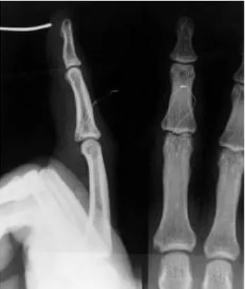 Fig. 4. Postoperative radiograph shwoing volar arthroplasty with pull-out wire technique