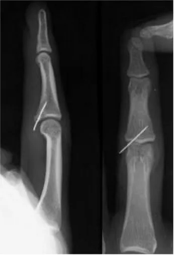 Fig. 5. This lateral(left) and posteroanterior(right) view of postoperative radiographs showing internal fixation with one 24G needle with the tip embedded in the subcutaneous layer.