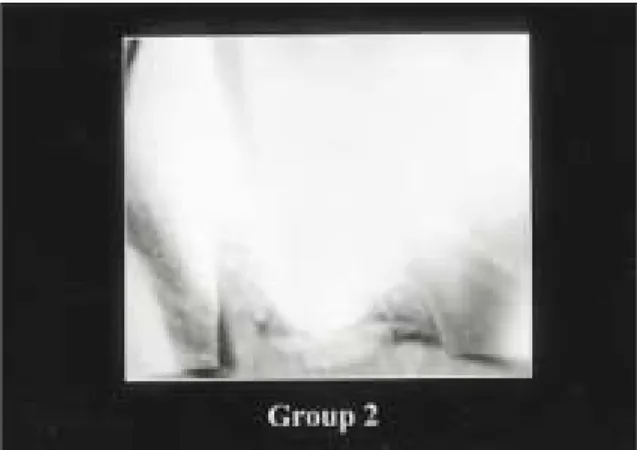Fig. 3. Leakage  of  group  I  sample  scoring  4  which  is leakage to the occlusal surface(×25).