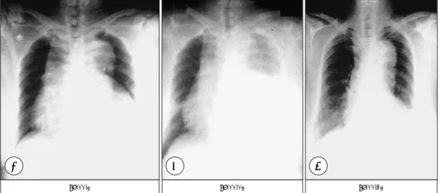 Fig. 6. Serial chest X-ray films showing dramatic decrease of mediastinal widening and left pleural effusion in a patient with proximal aortic intramural hematoma treated medically