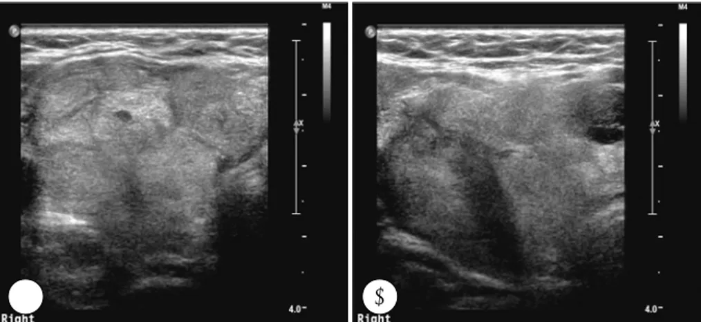 Fig. 1. Neck ultrasonographic findings. A：Isoechoic huge mass in the right thyroid gland