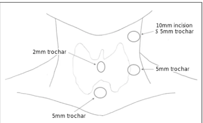 Fig. 4. Trochar incision site at initial operation.