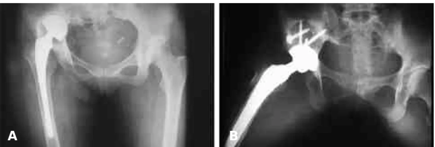 Fig. 2. (A) The superior migration of acetabular cup is noted at 3.5 years after surgery
