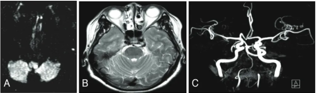 FIGURE 1. Brain MRI and MRA of the patient. Axial diffusion-weighted image (A) shows acute lateral medullary infarction and axial T2- T2-weighted image (B) and MRA (C) show the left persistent trigeminal artery connecting the carotid and the basilar artery