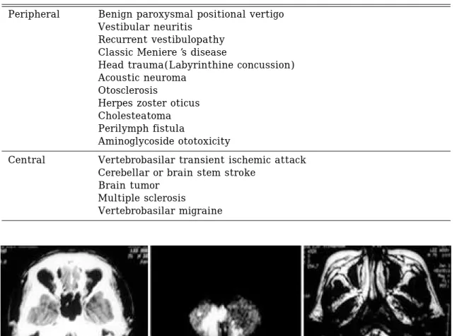 그림 3 . 후하소뇌동맥(PICA) 영역 소뇌경색 환자의 CT, DWI, T2 weighted MRI 소견. 75세남자 환자로 오전 5시경 깨